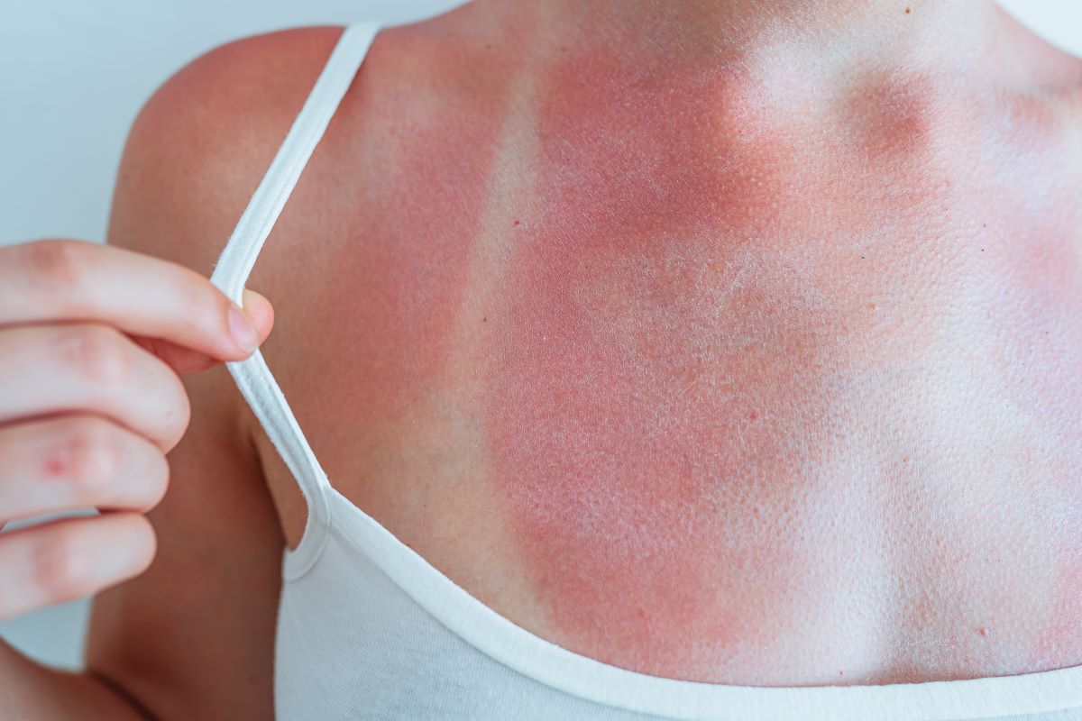 Sonnenbrand in Freudenstadt – so schützt du dich richtig und
